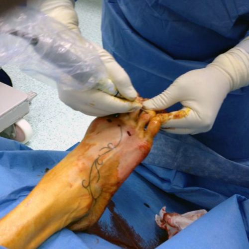 Un caso di sovraccarico metatarsale estremo