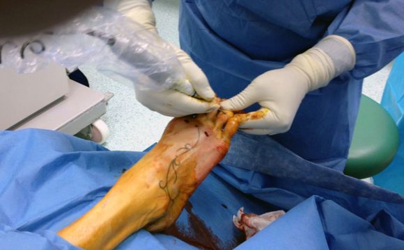 Un caso di sovraccarico metatarsale estremo