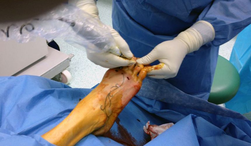 Un caso di sovraccarico metatarsale estremo