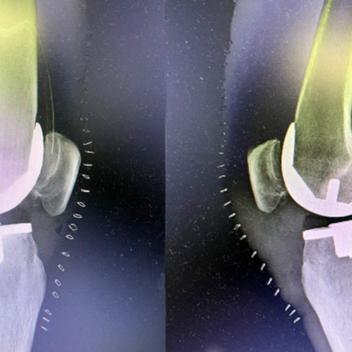 ROSA-Knee Sistema ROSA Knee