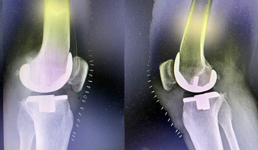 Sistema ROSA Knee