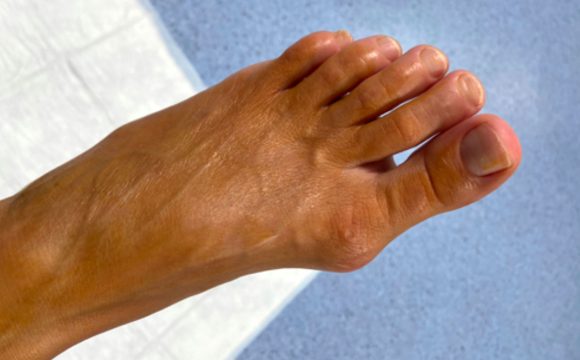6 motivi per ricorrere alla correzione percutanea mininvasiva dell’alluce valgo