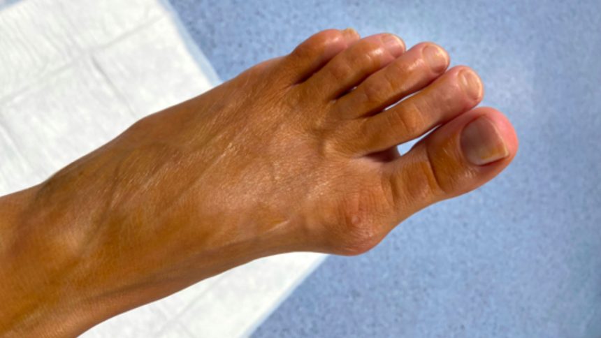 6 motivi per ricorrere alla correzione percutanea mininvasiva dell’alluce valgo