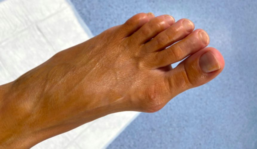 6 motivi per ricorrere alla correzione percutanea mininvasiva dell’alluce valgo