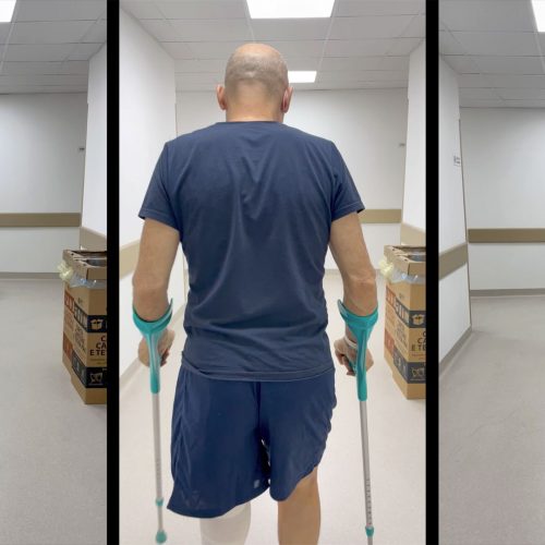 ROSA Knee: ottimi risultati a pochi giorni dall’intervento.
