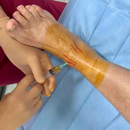 infiltrazioni-cellule-staminali Cellule staminali: non limitiamoci al ginocchio!